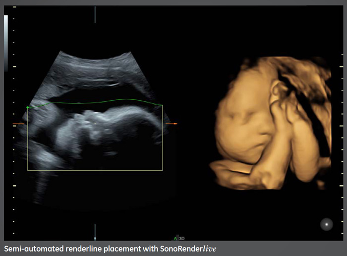 5D Ultrasound