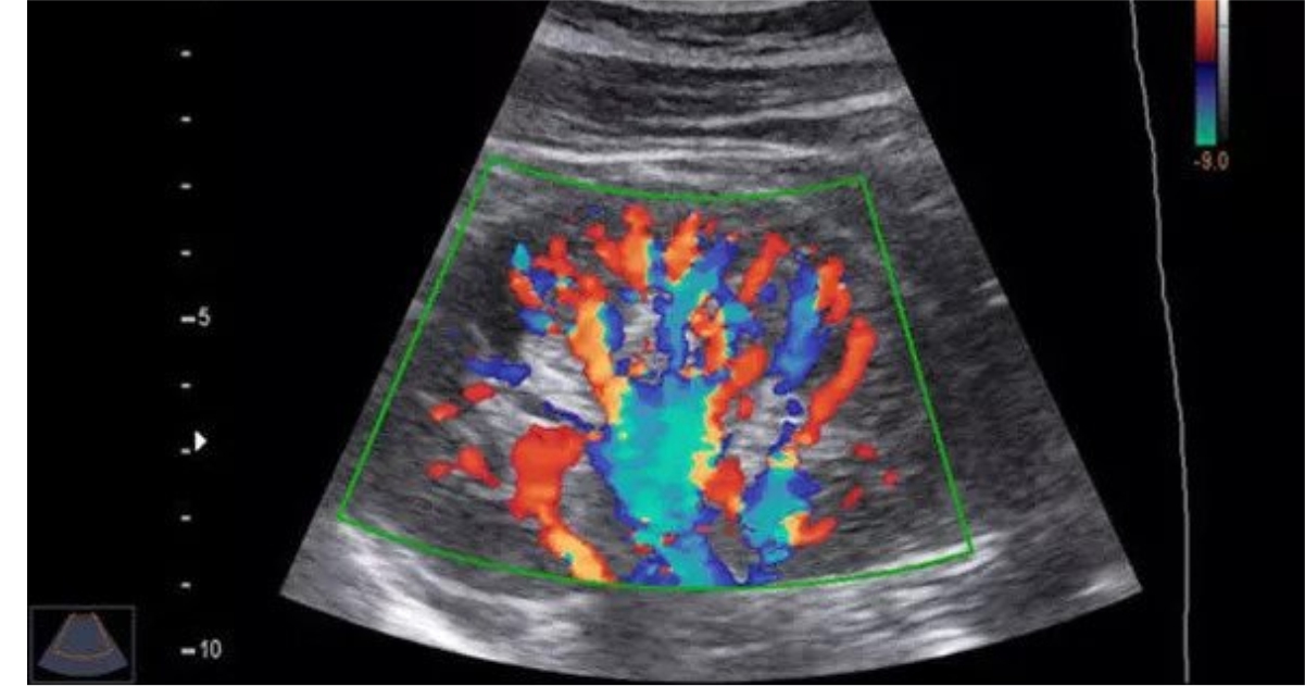 Doppler Ultrasound