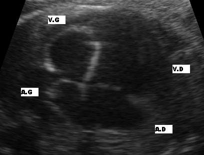 Fetal Echocardiography