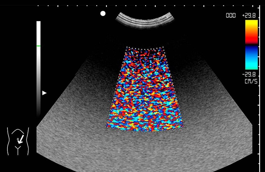 Fetal Doppler Study