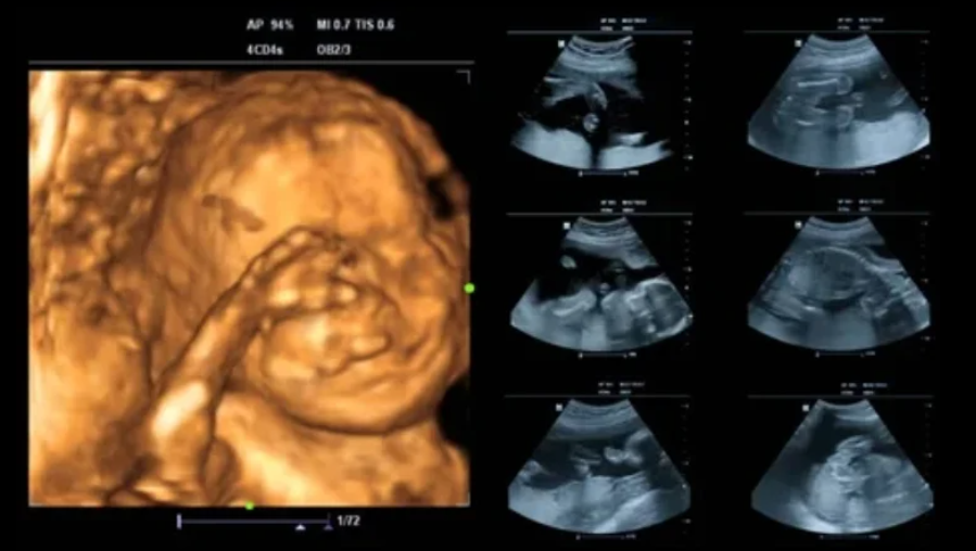 How 5D Ultrasound Supports Early Diagnosis / ५डी अल्ट्रासाउन्डले प्रारम्भिक रोग पत्ता लगाउन कसरी सहयोग गर्छ